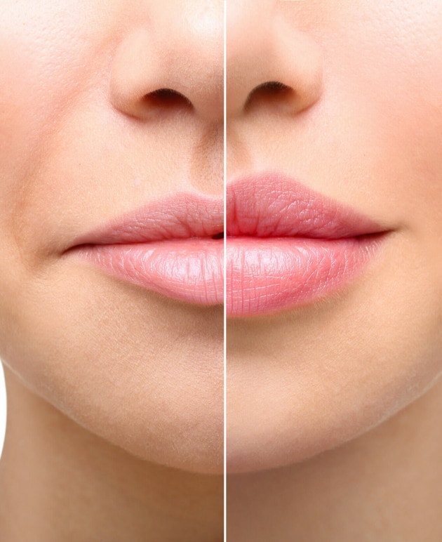 Ein Vorher und Nachher Bild von Lippen.